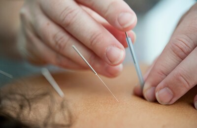 Acupuncture Coquitlam Alpha massage Therapy and Wellness